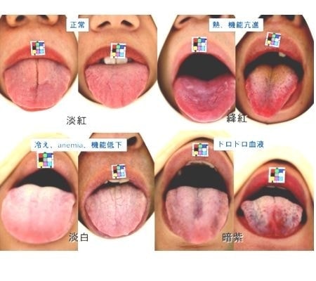 和泉市くぼ歯科/舌診
